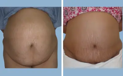 Tummy tuck before and after result 17 - abdominoplasty performed in India, IndiCure patient
