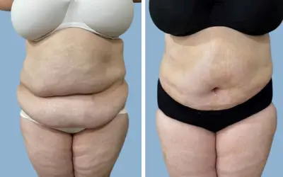 Tummy tuck before and after result 19 - abdominoplasty performed in India, IndiCure patient