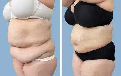 Tummy tuck before and after result 20 - abdominoplasty performed in India, IndiCure patient
