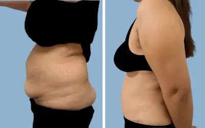Tummy tuck before and after result 21 - abdominoplasty performed in India, IndiCure patient