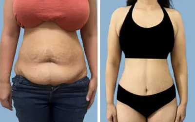 Tummy tuck before and after result 22 - abdominoplasty performed in India, IndiCure patient