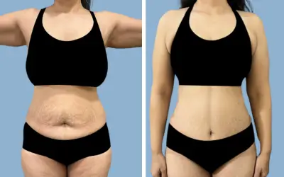 Tummy tuck before and after result 23 - abdominoplasty performed in India, IndiCure patient