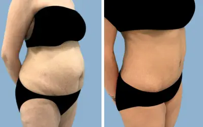 Tummy tuck before and after result 24 - abdominoplasty performed in India, IndiCure patient