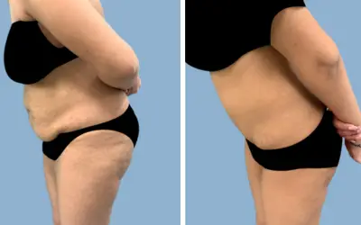 Tummy tuck before and after result 25 - abdominoplasty performed in India, IndiCure patient