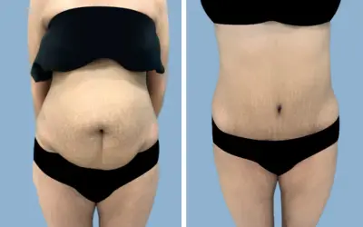 Tummy tuck before and after result 26 - abdominoplasty performed in India, IndiCure patient