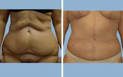 Tummy tuck before and after result 3 - abdominoplasty performed in India, IndiCure patient
