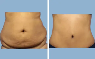 Tummy tuck before and after result 4 - abdominoplasty performed in India, IndiCure patient