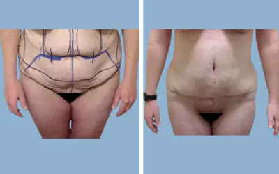 Tummy tuck before and after result 5 - abdominoplasty performed in India, IndiCure patient