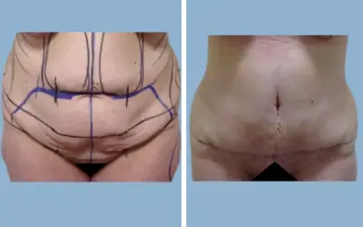 Tummy tuck before and after result 6 - abdominoplasty performed in India, IndiCure patient
