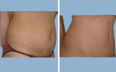 Tummy tuck before and after result 7 - abdominoplasty performed in India, IndiCure patient