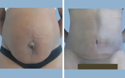 Tummy tuck before and after result 8 - abdominoplasty performed in India, IndiCure patient