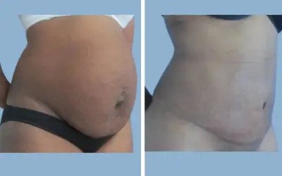 Tummy tuck before and after result 9 - abdominoplasty performed in India, IndiCure patient
