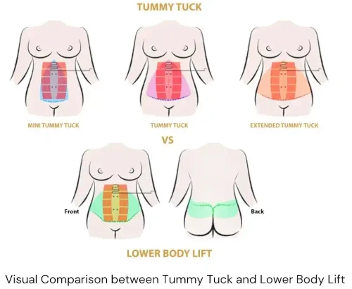 How to Get Rid of Excess Skin After Weight Loss?