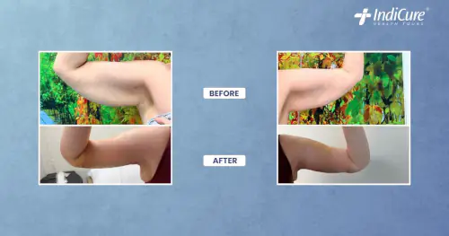 Revision arm lift in India: before and after photos one week after surgery