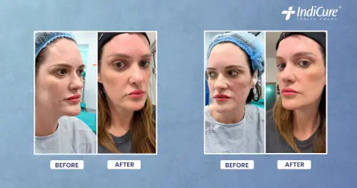 Facelift and neck lift in India: before and after side profile with early swelling