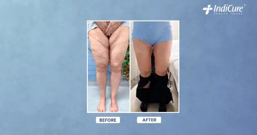Thigh lift in India: before and after results for a 54-year-old US patient