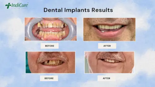 dental-implants-treatment-in-india-before-after