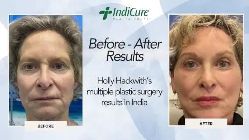 Holly Hackwith's multiple plastic surgery results in India