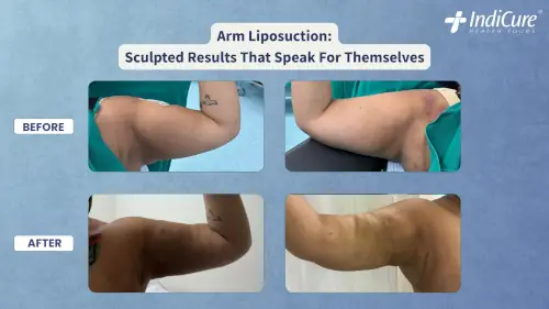 Before and after results of arm liposuction in India for an Australian patient.